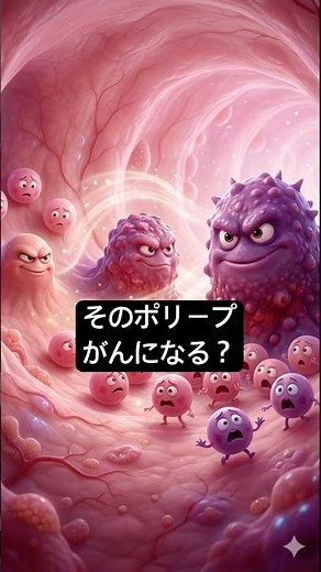 そのポリープ、がんになる？｜大腸ポリープと腺腫