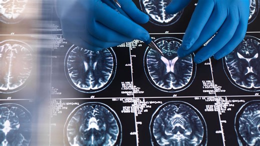 New Vitamin-Based Compound Could Restore Brain Function Lost to Alzheimer's