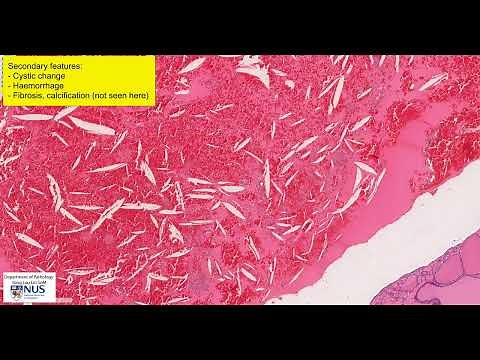 Thyroid: Multinodular goitre Microscopy - Talking slide