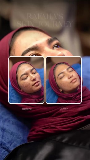 Before and After of Combo Treatment Perfect for Acne and Congested Skin Watch this incredible transformation as our client experiences the power of our triple-action skin treatment! ✨ First, our Signature HydraFacial deeply cleansed and hydrated, then the Dr. Belter fruit acid peel gently exfoliated to reveal fresh skin beneath. Finally, our expert esthetician performed precise Dr. Belter Line A comedon extractions to clear congestion. The results speak for themselves! Notice how the combination