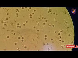 Pus cells in urine microscopy