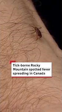 Tick-borne Rocky Mountain spotted fever spreading in Canada