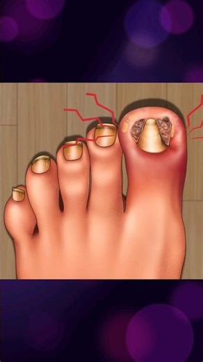 ASMR Ingrown Toenail Fix 🦶✨#animation #foot