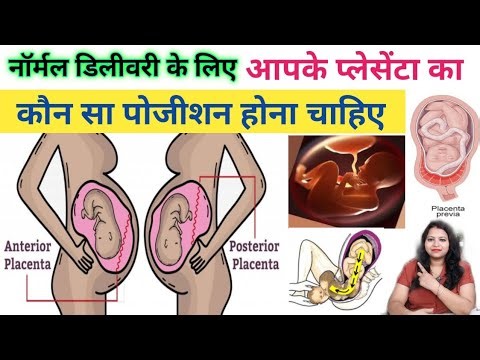 प्लेसेंटा पोजिशन से जाने आपकी नॉर्मल डिलीवरी होगी या सिजेरियन।Placenta kya hai kaise kaam karta hai।