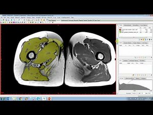 How to Segment Muscles Semi-Automatically With the Muscle Segmentation Tool | Materialise Medical