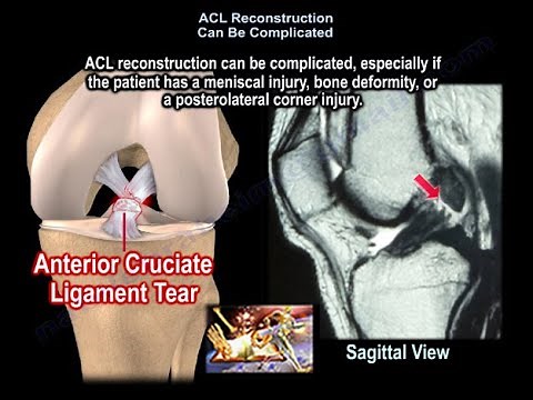 ACL Reconstruction Can Be Complicated - Everything You Need To Know - Dr. Nabil Ebraheim
