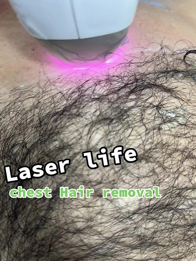 Laser life #1millionviews #5millionviews