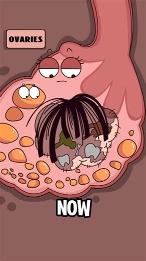 Health | Animation | Body | | Ever heard of a teratoma? 👀 It’s a rare type of tumor that forms when certain cells grow in the wrong direction — like they’re confused... | Instagram