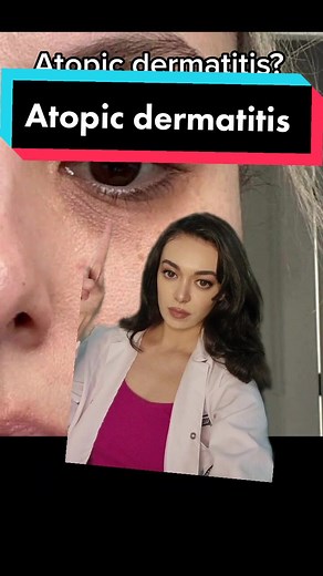 Understanding Atopic Dermatitis: Causes, Symptoms, and Treatment