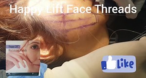 Happy Lift threads. Non surgical, safe and effective way of addressing signs of ageing like jowling and sagging. #happylift #facelift | Clara V Clinic