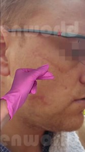 DP4 Exosome Microneedling Skin Refresh
