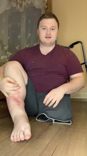 Understanding Bruises: Causes and Care Tips