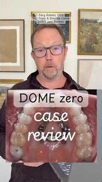 DOME zero case review - adult palatal expansion #domezero #maspe #marpe #palatalexpansion