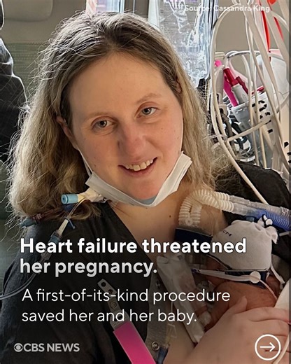 CBS News on Instagram: "The Impella 5.5 had previously been used in pregnancy-related cases only about a dozen times. Cassandra King’s case is the first time doctors have used the device help a patient from a non-viable stage of pregnancy to where her baby could be safely delivered. “It was very clear we were kind of creating the path here. ... We were constantly weighing risks and benefits.” - Dr. Bartlomiej Imielski, cardiothoracic surgeon. Link in bio for the full story."