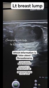 34K views · 182 reactions | #Fibroadenoma #sonographiccasestudy #healthcare #radiology #education #ultrasound #reelsviralシ #reelsfacebook | Sonographic case study | Facebook