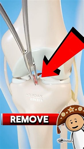 como é feita a CIRURGIA DE LCA?