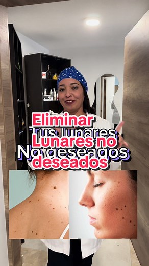 Eliminación de Lunares: Métodos y Consejos Útiles