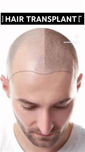 Best centre for Hair Transplant in Jaipur by Dr Nakul Somani, Plastic & Cosmetic Surgeon| 8290000117