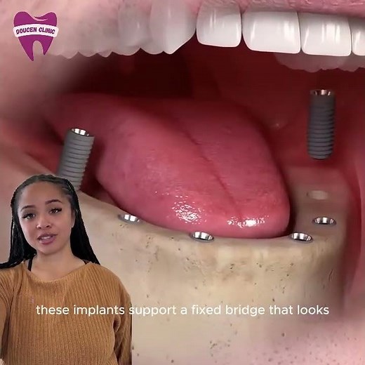 What is the All on 6 procedure?