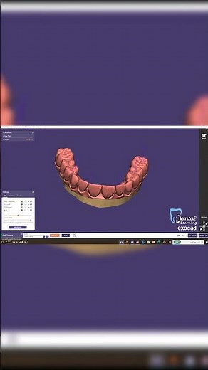 ibar design in exocad #anatomy #اكسبلور #ibars #exocad #chemnitz