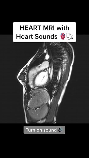 Exploring the Impact of Heart Beats on the Body | Heart MRI & Sounds