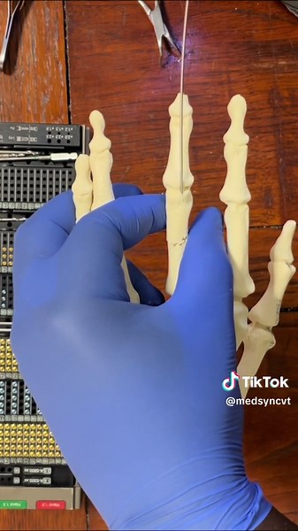 Using K Wires for Fracture Reduction: Step-by-Step Guide with Medartis Instruments