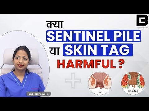 Sentinel Pile or Skin Tag - SKIN OVER ANUS ? | सेंटिनल पाइल या स्किन टैग क्या होता है? #analhealth