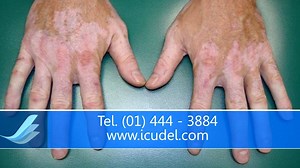 ¿Cuáles son las causas, síntomas y tratamientos para el Vitiligo? El Dr. José Luis Ballesteros explica en el siguiente video todas las dudas que tengas acerca de esta enfermedad, también puedes consultarnos en nuestra página web → http://goo.gl/G4JNJK Visítanos en: Pasaje Olaya 129 Consultorio 1504 Miraflores altura 1 y 2 de la Av. Pardo (costado del Banco de la Nación) telf: 01 444 - 3884 Atendemos de Lunes a Viernes de 10 am. a 1pm. y de 2 a 8 pm. Sábados de 8 am. - 2 pm | Iderma Capilar - Ins
