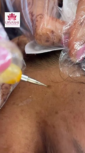 4 comments | Urvashi Beauty Studio and Spa #mole #removal #afterfacial #sosatisfied #soclean #offer #discount for more information #contact #2068591869 #bellevue #2063040311 #kent #urvashibeautyinternational | Urvashi beauty studio | Facebook