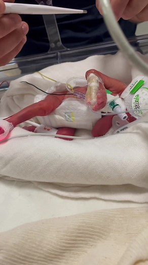 Survie des bébés prématurés - Témoignage d'une naissance à 27 SA