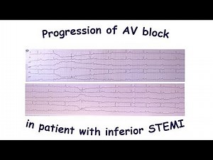 Progression of AV block in patient with inferior STEMI