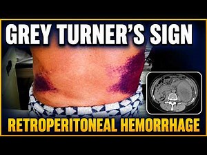 Grey Turner’s Sign | Retroperitoneal Hemorrhage