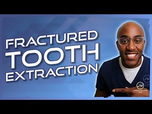 Fractured Tooth Removal - 3 Best Tips