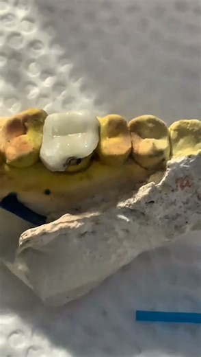 Onlay Restoration and PFM Crown Placement Procedure