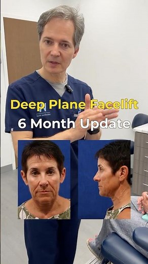 Scarless W Deep Plane Facelift - 6 Months Post-Op