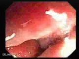 Severe case of Ischemic Colitis (7 of 19) • Video • MEDtube.net