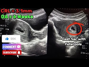 Sonogram: 6 Weeks Pregnant | Heartbeat 💓 | CRL | Fetal Pole | Yolk Sac
