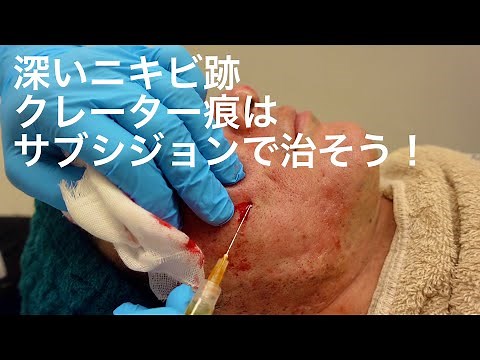 サブシジョン subcisionで深いニキビ跡のへこみ、クレーター痕を治そう！【皮膚科専門医が解説】