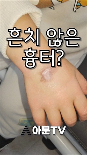 An Unusual Antibiotic Scar? (Plastic Surgery, Antibiotic Leakage, Vascular Scarring, Pain, Child'...