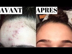 COMMENT SE DEBARRASSER DE L'ACNE ET MA ROUTINE SOINS | Andie Ella