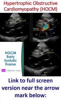 Hypertrophic Obstructive Cardiomyopathy (HOCM)