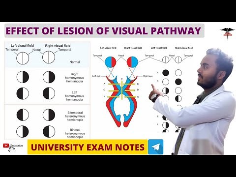 Effect Of Lesion On Visual Pathway || Special Sense Physiology