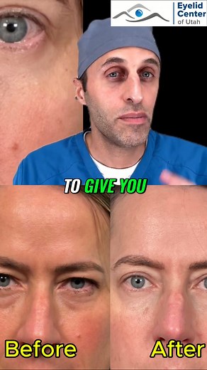 Curious about recovering from eyelid surgery? This unfiltered footage shows the entire process, from pre-op markings to final results. See the swelling, the stitches, and the amazing transformation. #Blepharoplasty #EyelidSurgery #PlasticSurgery #CosmeticSurgery #BeforeAndAfter | Eyelid Center of Utah | Facebook