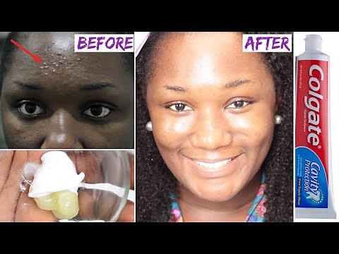 😱 I Applied toothpaste and vaseline on my face and See what happened the next day!