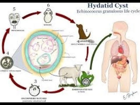 Cystic echinococcosis, Unilocular echinococcosis, Cystic hydatid disease