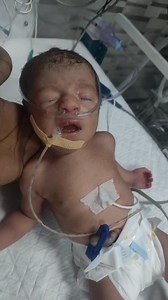 4.5K views · 144 reactions | Newborn CPAP support, baby respiratory distress, critical newborn care, NICU support, premature baby breathing problem, newborn health emergency #NewbornBaby #CPAPSupport #RespiratoryDistress #CriticalCondition #NICUCare #PrematureBaby #BabyCare #NewbornHealth #SaveTheBaby #PrayForBaby | Little Angel Care | Facebook