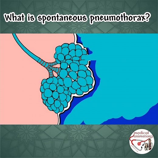 PNEUMOTHORAX
