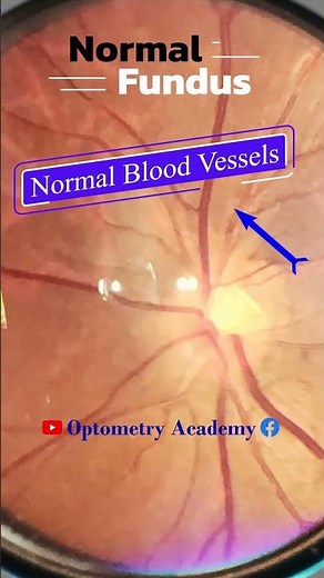 Normal fundus | Normal Retina | Smartphone Fundus Videography | Fundus Photography | Short Video 454