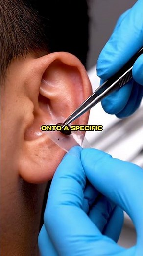 Ear Seeding Explained — Does It Really Work?