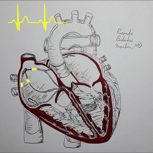 Sinus Arrest - Animation and ECG